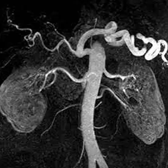 MR Angiography Renal With Contrast